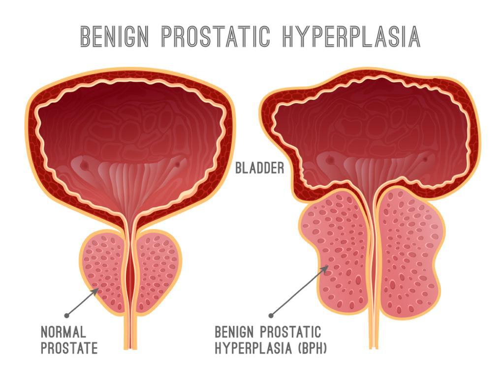 Best Benign Prostatic Hyperplasia Surgery In Dubai Prostate Gland Enlargement Bph